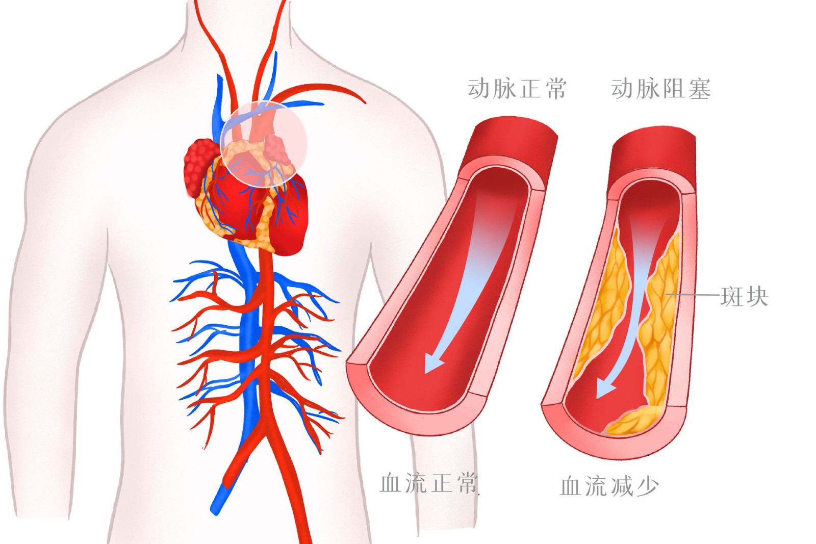 攝圖網(wǎng)_401802186_高血壓血管病變醫(yī)療插畫(企業(yè)商用).jpg
